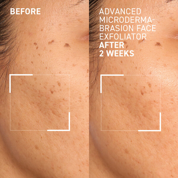 Advanced Microdermabrasion Face Exfoliator (Bilde 3 av 4)