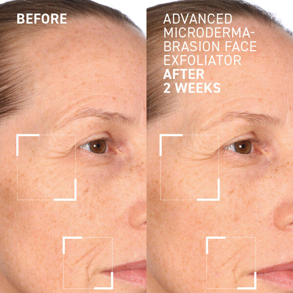 Advanced Microdermabrasion Face Exfoliator (Bilde 4 av 4)